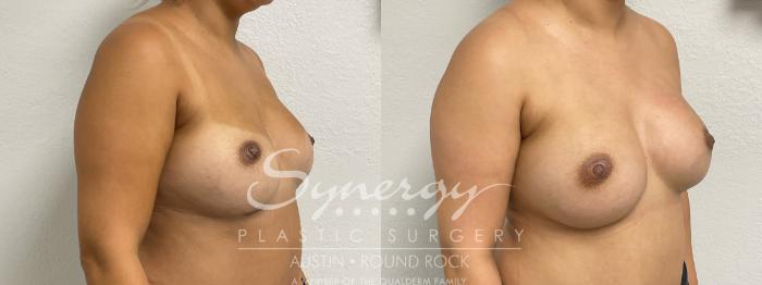 Before & After Revision Breast Augmentation Case 892 Right Oblique View in Austin, TX