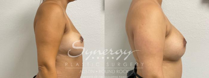 Before & After Revision Breast Augmentation Case 892 Right Side View in Austin, TX