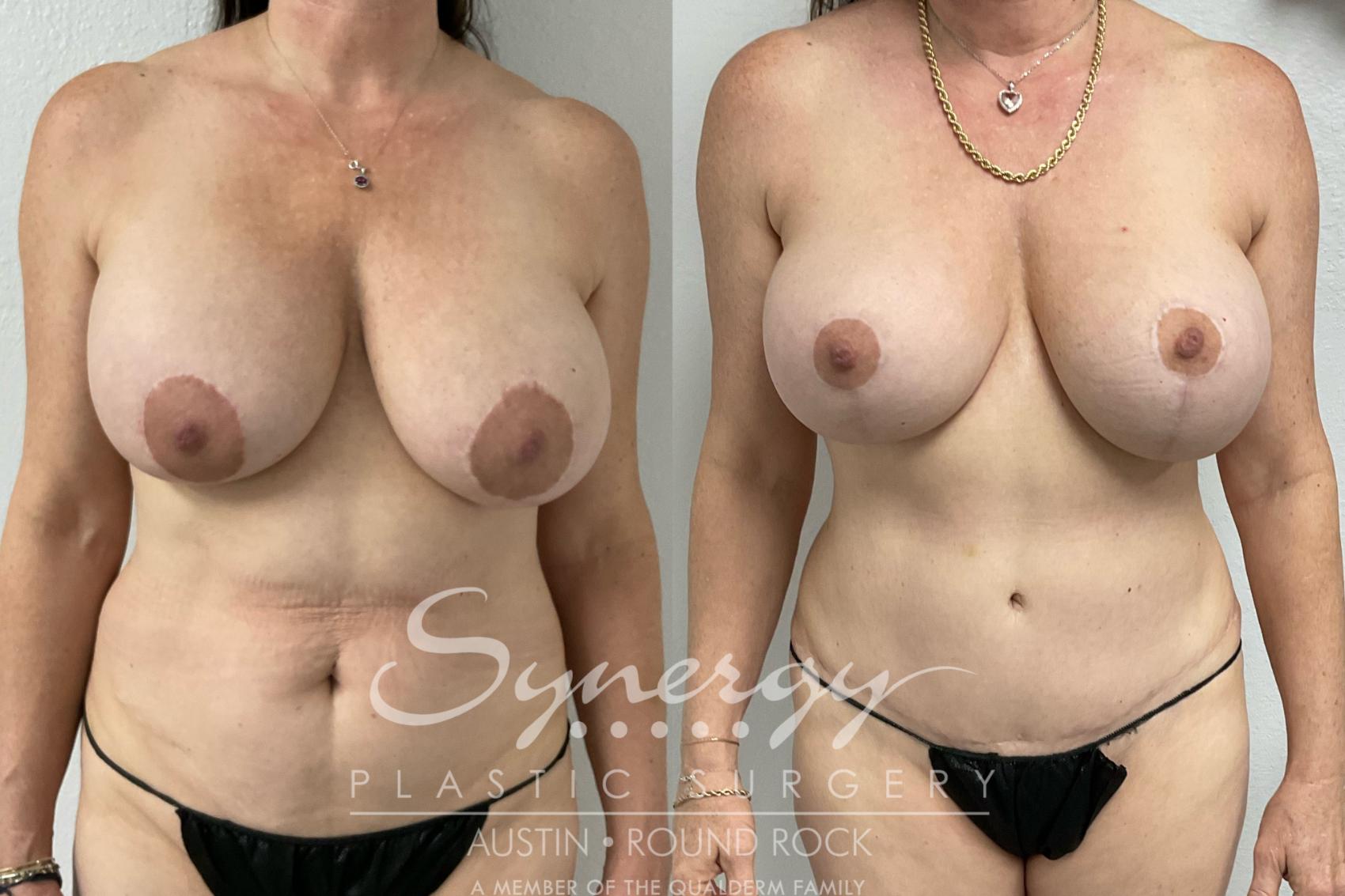 Before & After Revision Breast Augmentation Case 902 Front View in Austin, TX