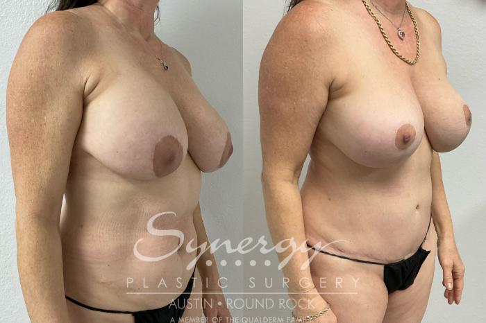 Before & After Revision Breast Augmentation Case 902 Right Oblique View in Austin, TX