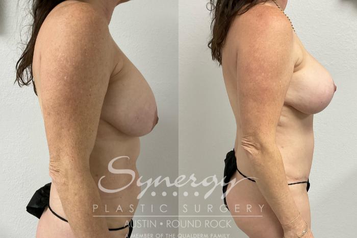 Before & After Breast Lift (Mastopexy) Case 902 Right Side View in Austin, TX