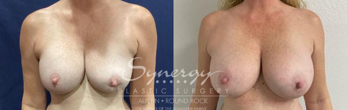 Before & After Revision Breast Augmentation Case 909 Front View in Austin, TX