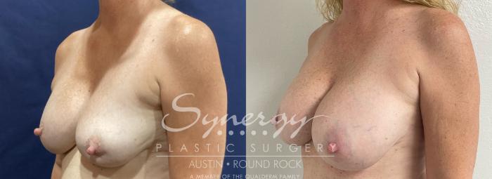 Before & After Revision Breast Augmentation Case 909 Left Oblique View in Austin, TX