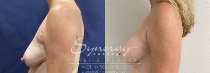 Before & After Revision Breast Augmentation Case 909 Left Side View in Austin, TX