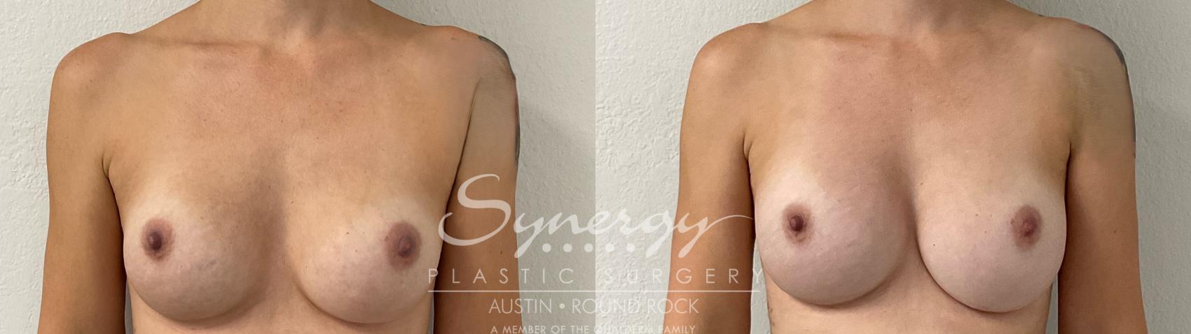 Before & After Revision Breast Augmentation Case 914 Front View in Austin, TX