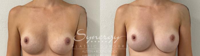 Before & After Revision Breast Augmentation Case 914 Front View in Austin, TX