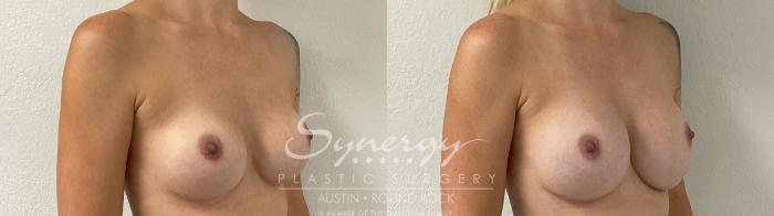 Before & After Revision Breast Augmentation Case 914 Right Oblique View in Austin, TX