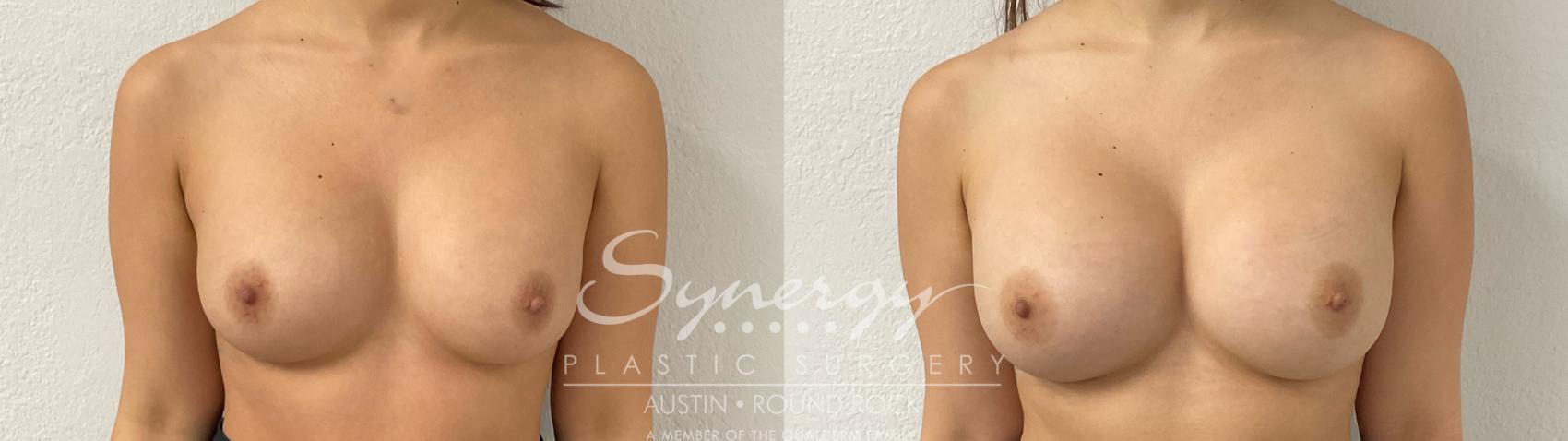 Before & After Revision Breast Augmentation Case 919 Front View in Austin, TX