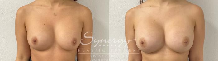 Before & After Revision Breast Augmentation Case 919 Front View in Austin, TX