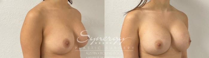 Before & After Revision Breast Augmentation Case 919 Right Oblique View in Austin, TX