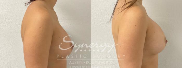 Before & After Revision Breast Augmentation Case 919 Right Side View in Austin, TX