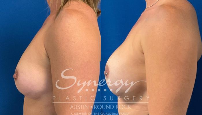 Before & After Revision Breast Augmentation Case 920 Left Side View in Austin, TX