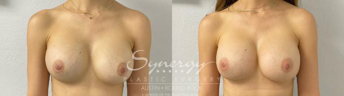 Before & After Revision Breast Augmentation Case 924 Front View in Austin, TX