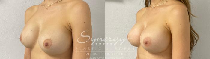 Before & After Revision Breast Augmentation Case 924 Left Oblique View in Austin, TX