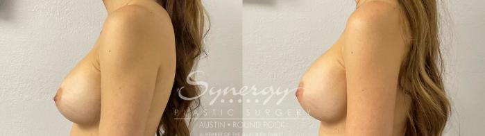 Before & After Revision Breast Augmentation Case 924 Left Side View in Austin, TX