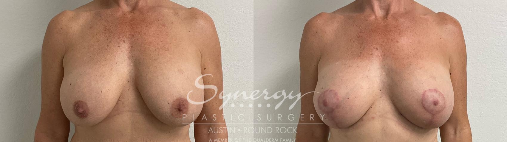 Before & After Breast Lift (Mastopexy) Case 925 Front View in Austin, TX