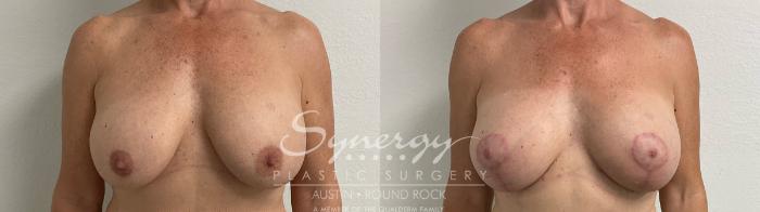 Before & After Revision Breast Augmentation Case 925 Front View in Austin, TX