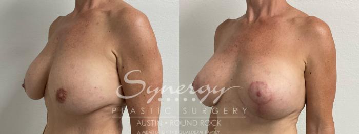 Before & After Breast Lift (Mastopexy) Case 925 Left Oblique View in Austin, TX