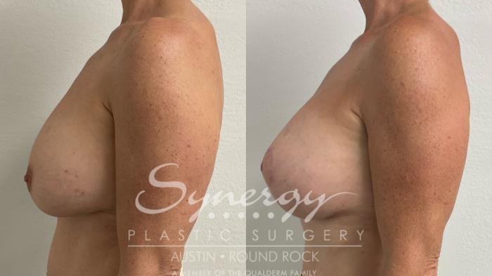 Before & After Revision Breast Augmentation Case 925 Left Side View in Austin, TX