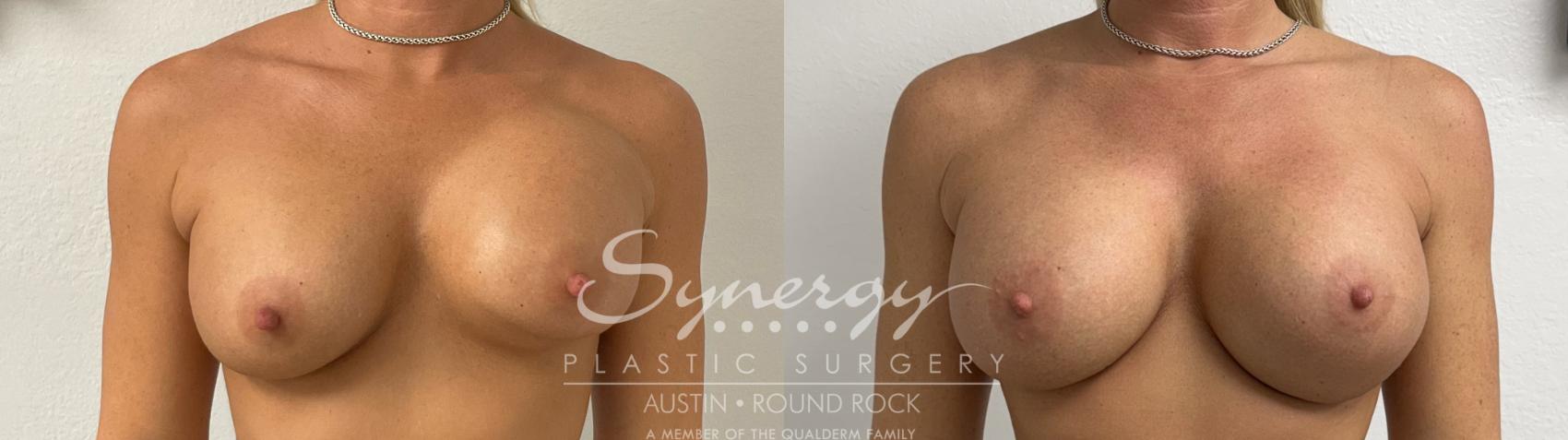 Before & After Revision Breast Augmentation Case 926 Front View in Austin, TX