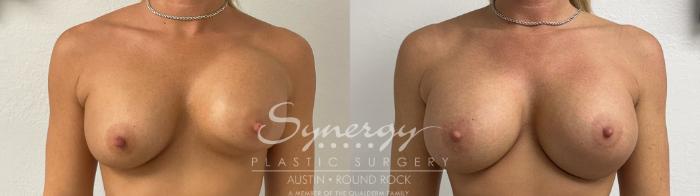 Before & After Revision Breast Augmentation Case 926 Front View in Austin, TX