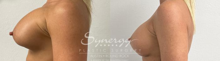 Before & After Revision Breast Augmentation Case 926 Left Side View in Austin, TX