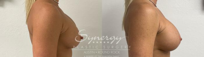 Before & After Revision Breast Augmentation Case 926 Right Side View in Austin, TX