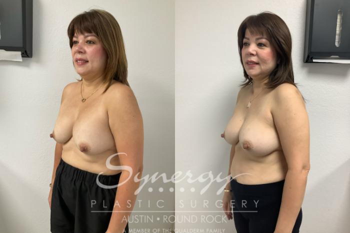 Before & After Revision Breast Augmentation Case 947 Left Oblique View in Austin, TX