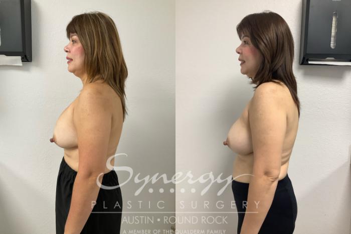 Before & After Revision Breast Augmentation Case 947 Left Side View in Austin, TX