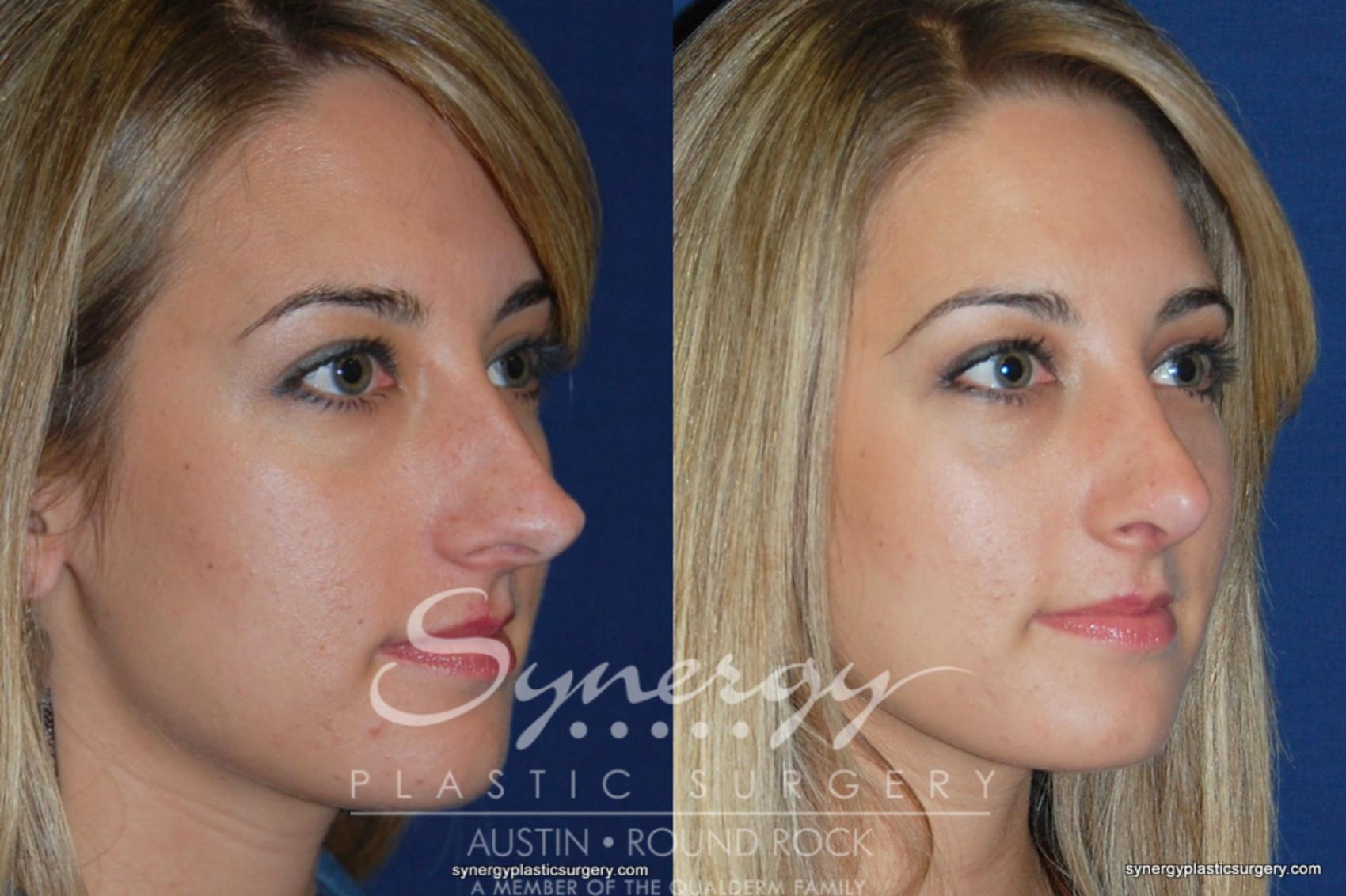 Rhinoplasty For Austin Texas Synergy Plastic Surgery