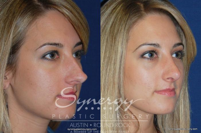 Before & After Rhinoplasty Case 200 View #1 View in Austin, TX
