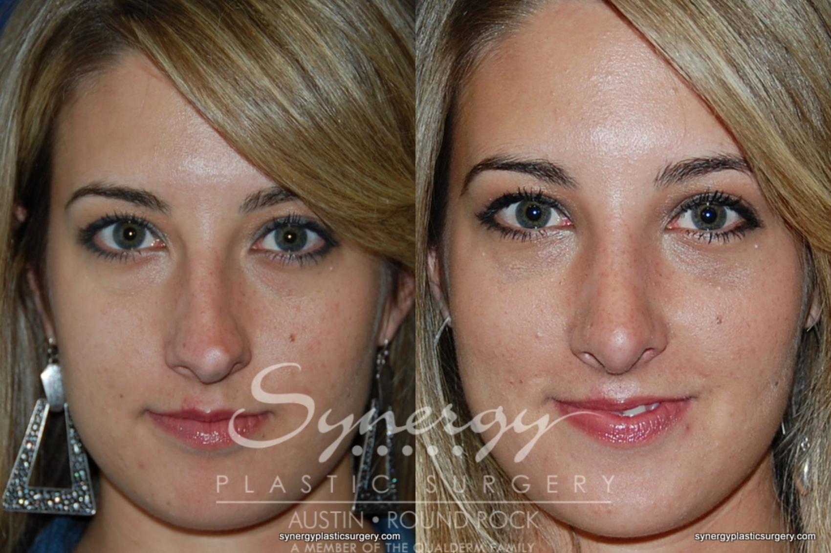 Rhinoplasty Before And After Pictures Case Austin TX Synergy Plastic Surgery