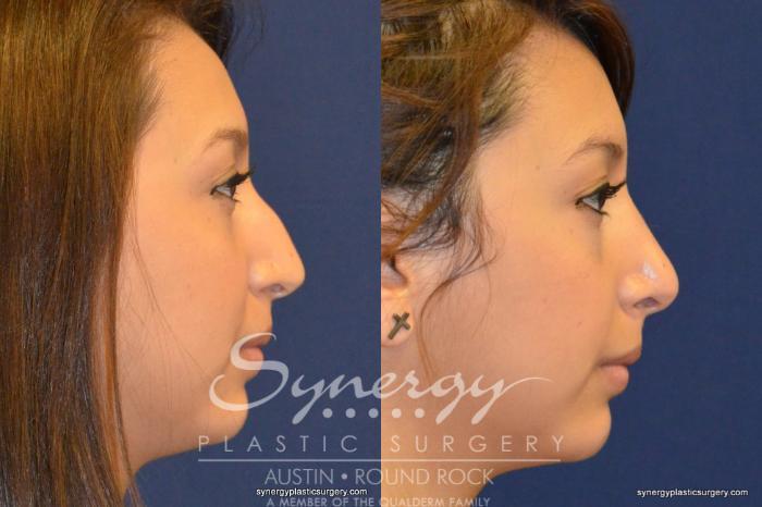 Before & After Rhinoplasty Case 201 View #1 View in Austin, TX