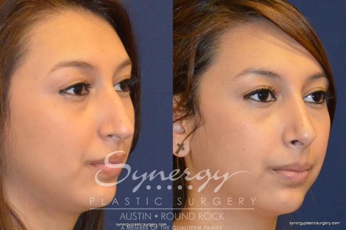 Before & After Rhinoplasty Case 201 View #2 View in Austin, TX