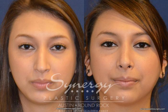 Before & After Rhinoplasty Case 201 View #3 View in Austin, TX