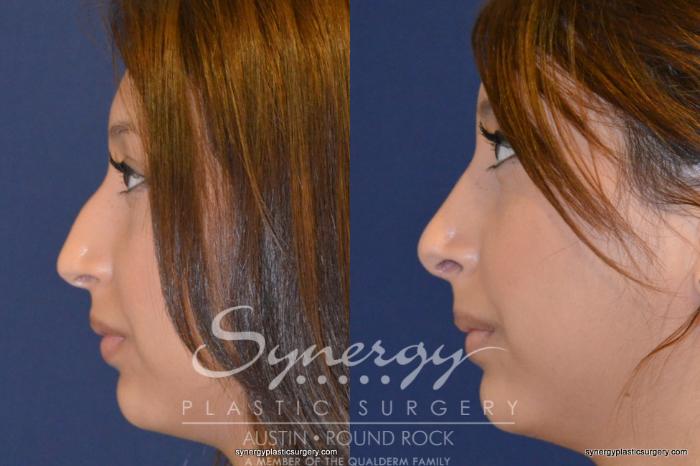 Before & After Rhinoplasty Case 201 View #4 View in Austin, TX