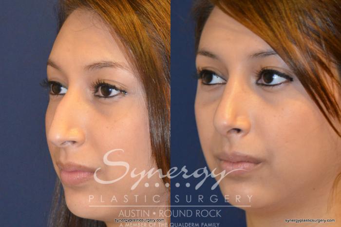 Before & After Rhinoplasty Case 201 View #5 View in Austin, TX
