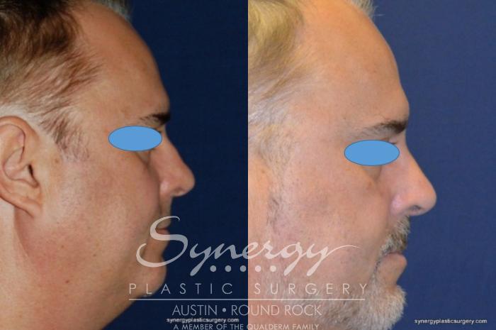 Before & After Rhinoplasty Case 209 View #1 View in Austin, TX