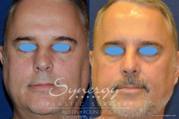 Before & After Rhinoplasty Case 209 View #2 View in Austin, TX