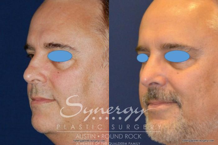 Before & After Rhinoplasty Case 209 View #3 View in Austin, TX