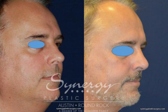 Before & After Rhinoplasty Case 209 View #4 View in Austin, TX