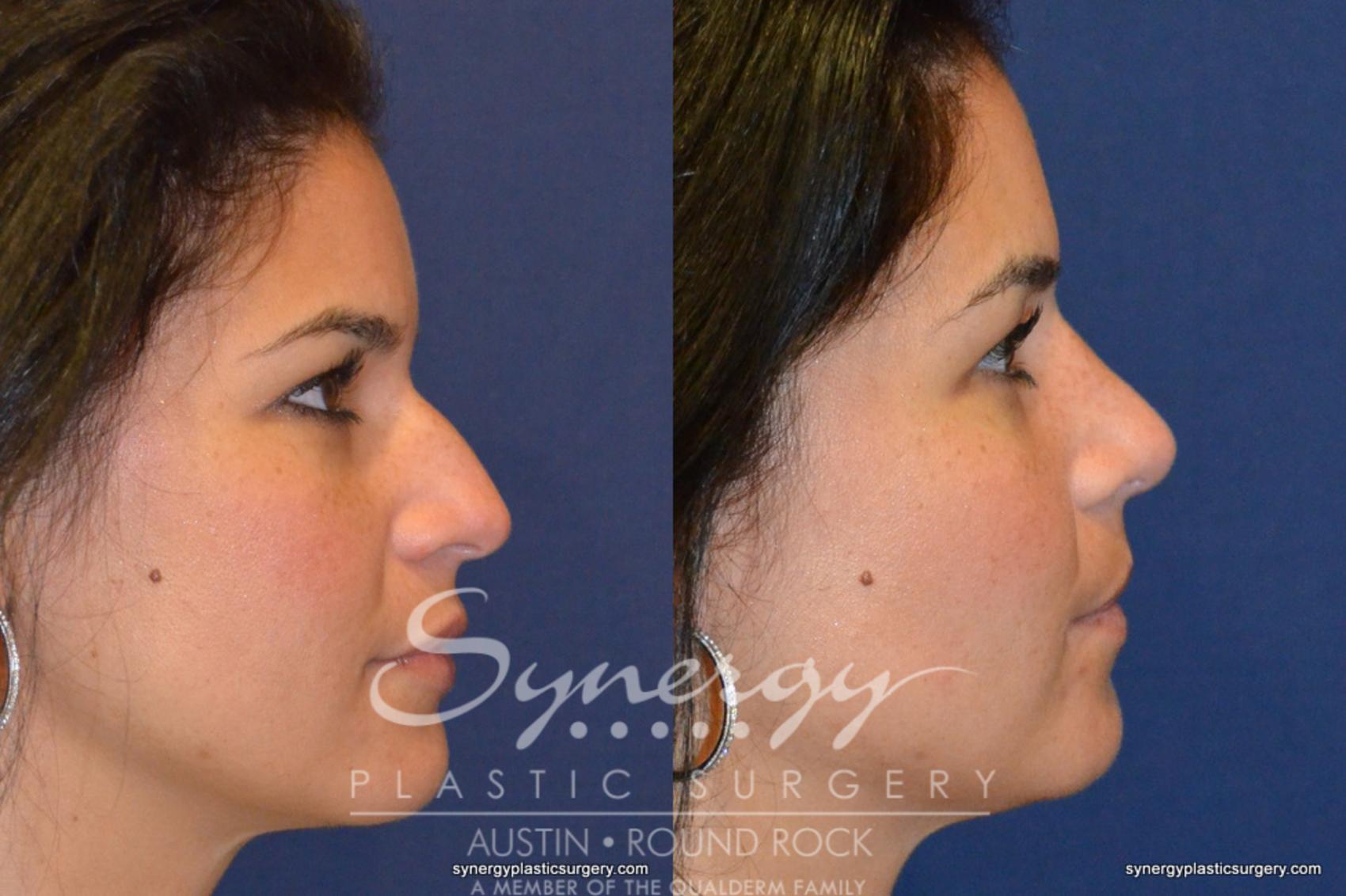 Before & After Rhinoplasty Case 227 View #1 View in Austin, TX