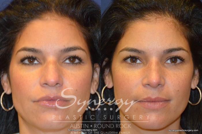 Before & After Rhinoplasty Case 227 View #2 View in Austin, TX