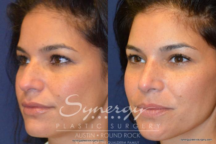 Before & After Rhinoplasty Case 227 View #3 View in Austin, TX