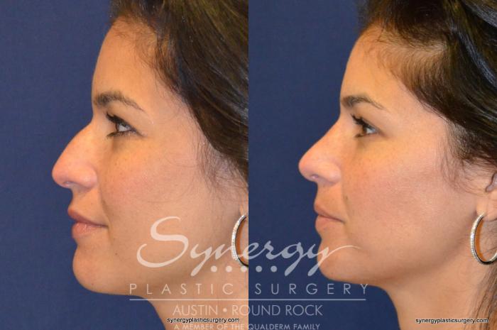 Before & After Rhinoplasty Case 227 View #4 View in Austin, TX
