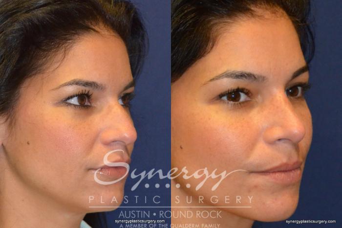 Before & After Rhinoplasty Case 227 View #5 View in Austin, TX