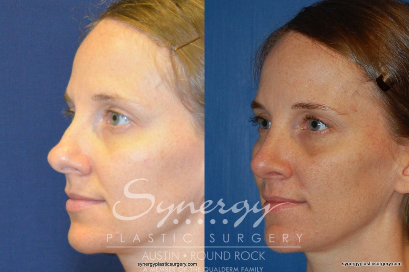 Before & After Rhinoplasty Case 244 View #1 View in Austin, TX