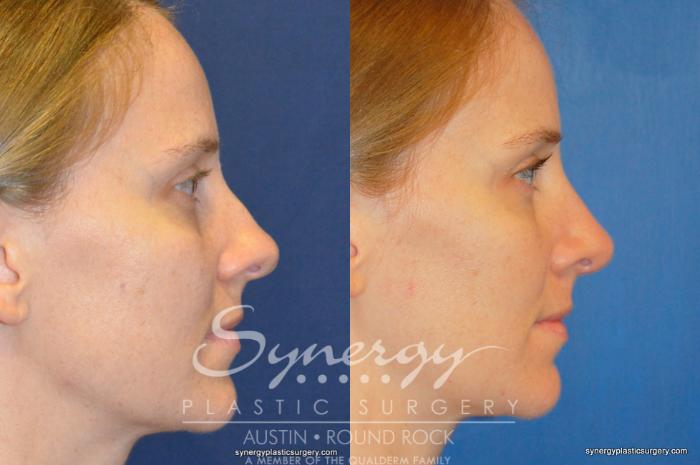 Before & After Rhinoplasty Case 244 View #2 View in Austin, TX