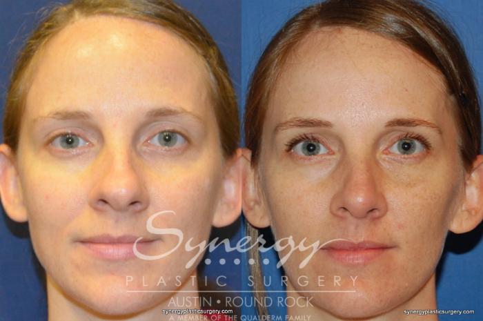 Before & After Rhinoplasty Case 244 View #3 View in Austin, TX
