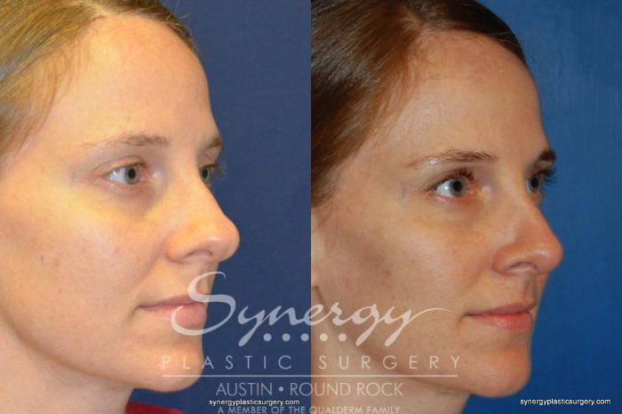 Before & After Rhinoplasty Case 244 View #4 View in Austin, TX